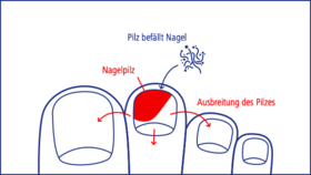 Ausbreitung von Nagelpilz