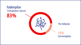 Fadenpilze sind zu 83% die Ursache für Nagelpilz